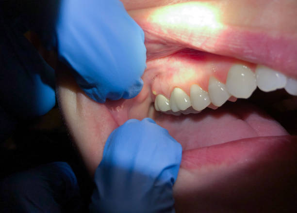 Best Emergency Dental Extractions in East Harwich, MA