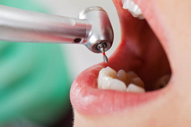 Best Emergency Dentist for Lost Fillings or Crowns in East Harwich, MA